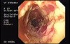 Oropharynge-Esophagic Candidiasis (1 of 5)