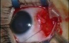 BMR For Infantile Esotropia - Hang-Back Technique