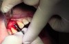 Implant Placement #5 - ID Screwplant System
