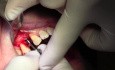 Implant Placement #5 - ID Screwplant System