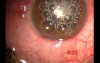 Traumatic Glaucoma & Uveitis - Microtrack Filtration