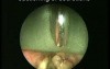 Biopsy of Ventricular Polyp