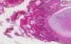 Squamous cell carcinoma - Histopathology - Lung