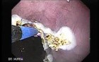 Barrett's Esophagus of long segment (8 of 11)