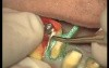 Finishing Preparations - Prosthetic Rehabilitation (3/3)