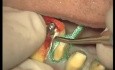 Finishing Preparations - Prosthetic Rehabilitation (3/3)