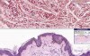 Xanthoma