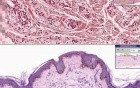 Xanthoma