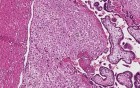 Retinoblastoma