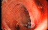 Bleeding From Sigmoid Diverticula