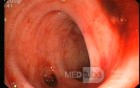Bleeding From Sigmoid Diverticula