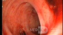 Bleeding From Sigmoid Diverticula
