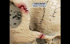 Volumated Skull Fractures