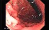 Adenocarcinoma of the Lesser Curvature with Signet Ring Cells (5 of 8)