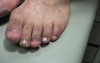 Stage-4 Ingrown Toenail—6 Months Later