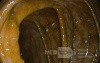 Endoscopic appearance of the Pseudomembranous colitis