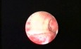 Hysteroscopic Treatment Of Osteoid Metaplasia