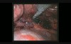 Bleeding Control by Uniportal VATS Right Upper Lobectomy