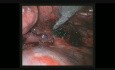 Bleeding Control by Uniportal VATS Right Upper Lobectomy