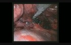 Bleeding Control by Uniportal VATS Right Upper Lobectomy