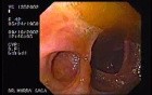 Ileum-transverse Anastomosis (1 of 3)