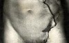 Arrow Injury Of The Abdomen