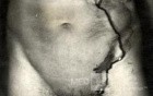 Arrow Injury Of The Abdomen