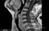 Esophageal Squamous Cell Carcinoma of the the upper third of the Esophagus that invades the subglotic (5 of 8)