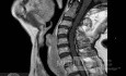 Esophageal Squamous Cell Carcinoma of the the upper third of the Esophagus that invades the subglotic (5 of 8)