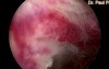 Hysteroscopic Excision of Endometrium