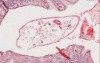 Pinworms