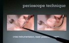 Technique of Perioscopy