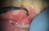 Poorly Fabricated Dental Fillings Correction