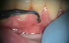 Poorly Fabricated Dental Fillings Correction