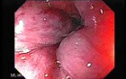 Prolapsed Hemorrhoid (4 of 4)