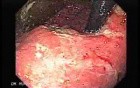 Synchronous Cancer (Gastric and Esophageal) - Extensive Infiltration of the Fundus and Body