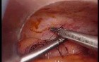 Colonic Perforation With Peritonitis - Laparoscopy (12 of 46)