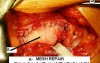 Open Mesh Repair Of Inguinal Hernia - Intra-Operative Photo