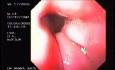Banding of esophageal varices (10 of 17)