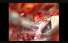 Brain Aneurysm - Internal Carotid Artery Bifurcation Aneurysm