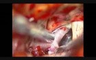 Brain Aneurysm - Internal Carotid Artery Bifurcation Aneurysm