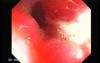 Adenocarcinoma of the Transverse Colon (3 of 5)