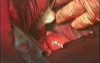 Esophageal Cancer Surgery - Cancer In Lower/3