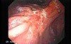 Adenocarcinoma of the Lesser Curvature with Signet Ring Cells (2 of 3) 2