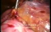 Aorto Caval Lymphnode - Laparoscopic Approach