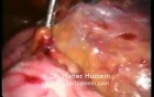 Aorto Caval Lymphnode - Laparoscopic Approach