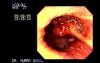  Large and long stalk villous adenoma inserting in the rectal dentate line, appearing as a multi lobular mass (1 of 2)