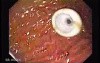 Percutaneous Endoscopic Gastrostomy - PEG (4 of 6)
