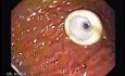 Percutaneous Endoscopic Gastrostomy - PEG (4 of 6)