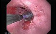 Endoscopic Baloon Dilation Of The Esophageal Stricture - Position Of The Inflated Baloon - 1/8